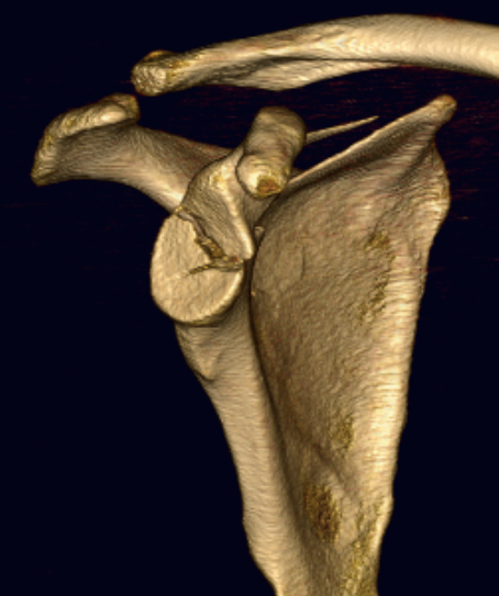 Glenoid Fracture 3